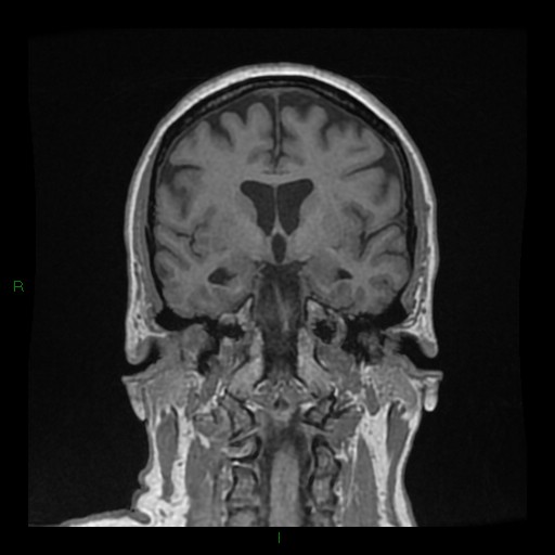 Cerebellar abscess (Radiopaedia 78135-90678 Coronal T1 C+ 76).jpg