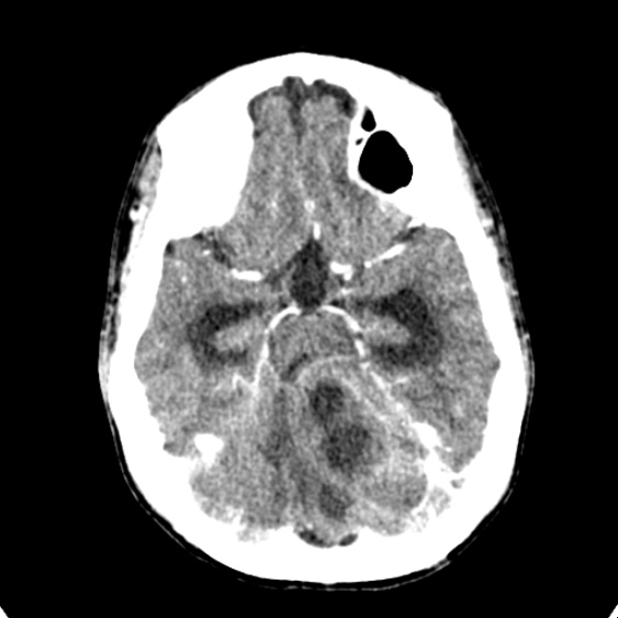 Cerebellar abscess secondary to mastoiditis (Radiopaedia 26284-26412 Axial C+ delayed 53).jpg