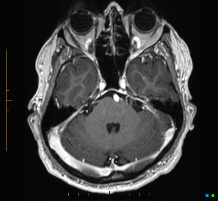 Cerebellar gangliocytoma (Radiopaedia 65377-74422 Axial T1 C+ 31).jpg