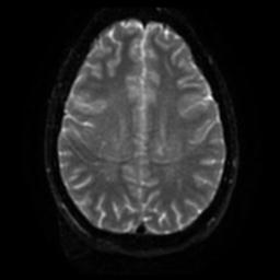 Cerebellar hemangioblastoma (Radiopaedia 29570-30077 Axial DWI 44).jpg