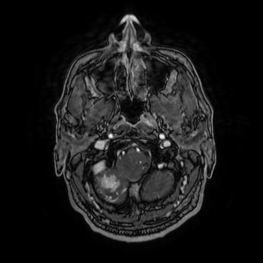 File:Cerebellar hemangioblastoma (Radiopaedia 88055-104622 Axial T1 C+ 33).jpg