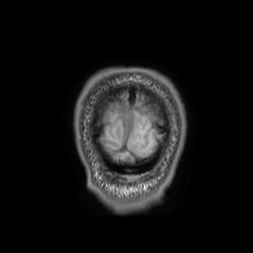 File:Cerebellar hemangioblastoma (Radiopaedia 88055-104622 Coronal T1 36).jpg