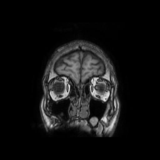 File:Cerebellar hemangioblastoma (Radiopaedia 88055-104622 Coronal T1 5).jpg