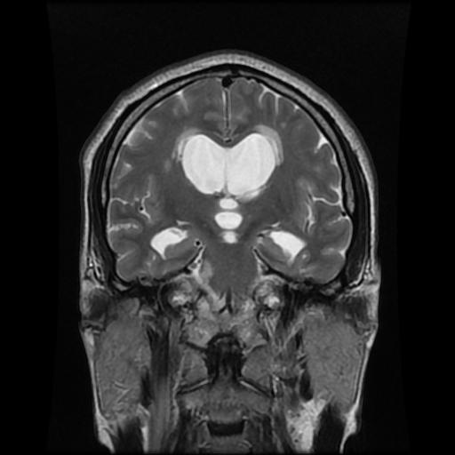 File:Cerebellar hemangioblastoma (Radiopaedia 88055-104622 Coronal T2 7).jpg