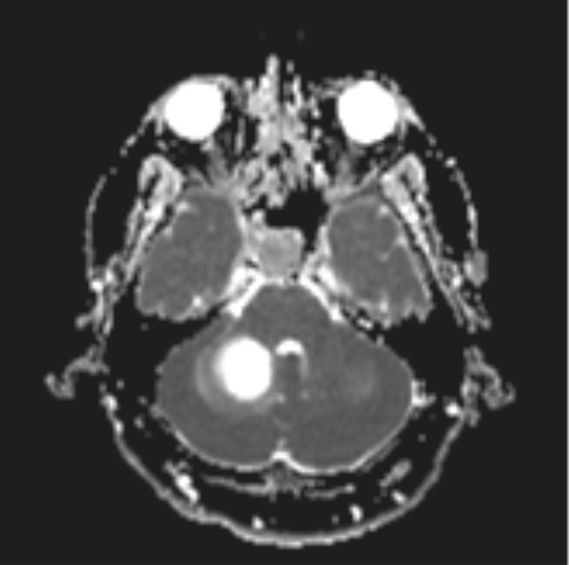File:Cerebellar hemangioblastomas and pituitary adenoma (Radiopaedia 85490-101176 Axial ADC 9).png