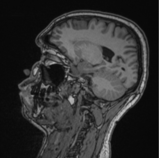 Cerebellar hemangioblastomas and pituitary adenoma (Radiopaedia 85490-101176 Sagittal T1 44).png