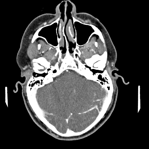 Cerebellar infarct due to vertebral artery dissection with posterior fossa decompression (Radiopaedia 82779-97029 C 19).png