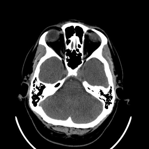 File:Cerebellar infarction (Radiopaedia 16625-16327 Axial non-contrast 11).jpg