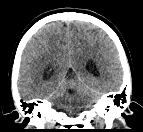 Cerebellar metastases - colorectal adenocarcinoma (Radiopaedia 40947-43652 Coronal non-contrast 63).png