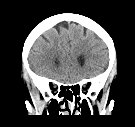 Cerebellar metastasis (Radiopaedia 54578-60812 Coronal non-contrast 16).png