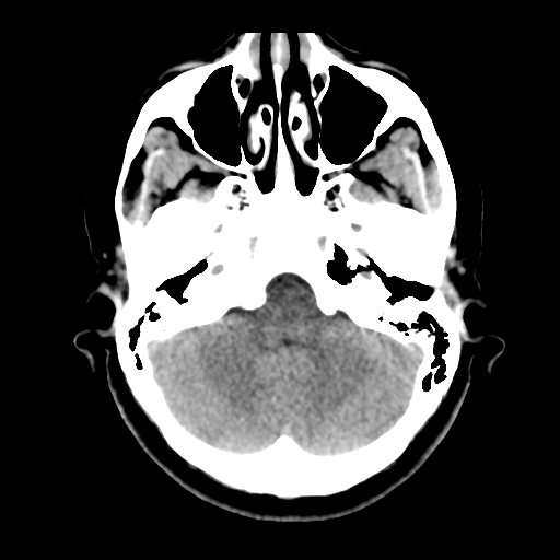 Cerebellar metastasis (cystic appearance) (Radiopaedia 41395-44258 Axial non-contrast 13).png