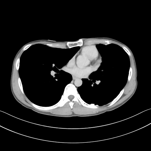 Cerebellar metastasis - adenocarcinoma lung (Radiopaedia 63184-71717 Axial C+ delayed 38).png