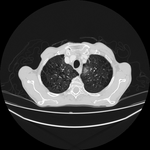 File:Cerebellar metastasis - lung tumor (Radiopaedia 69317-79150 Axial lung window 6).jpg