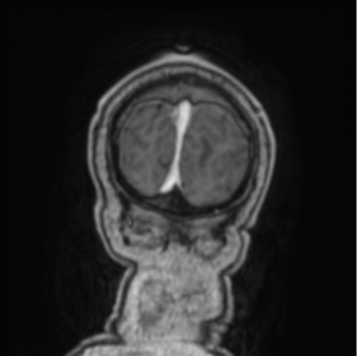 Cerebellar metastasis from lung adenocarcinoma (Radiopaedia 86690-102829 Coronal T1 C+ 8).png