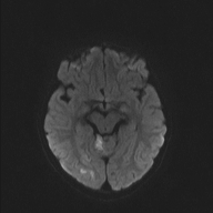 File:Cerebellar stroke (Radiopaedia 32202-33150 Axial DWI 33).png