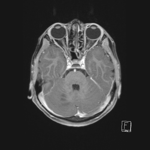 Cerebellar stroke (Radiopaedia 32202-33150 Axial T1 C+ 28).png