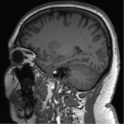 Cerebellopontine angle meningioma (Radiopaedia 48434-53348 Sagittal T1 60).png