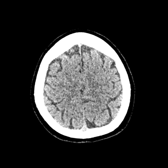 File:Cerebellopontine angle meningioma (Radiopaedia 53561-59592 Axial non-contrast 56).jpg