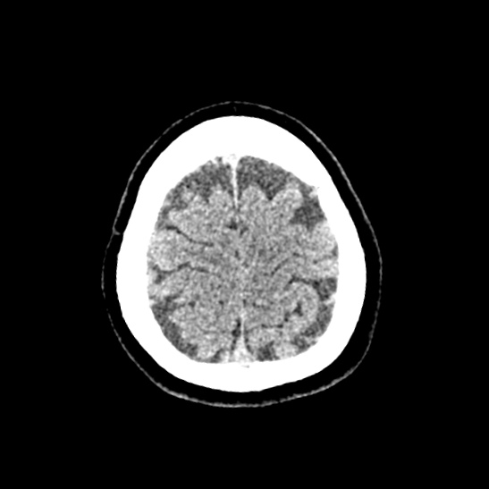 Cerebellopontine angle meningioma (Radiopaedia 53561-59592 Axial non-contrast 60).jpg