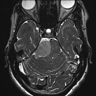 Cerebellopontine angle meningioma (Radiopaedia 72983-83680 Axial FIESTA 47).jpg