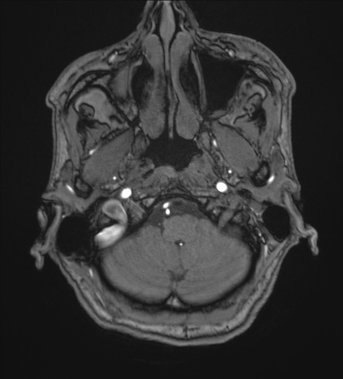Cerebellopontine angle meningioma (Radiopaedia 72983-83680 Axial MRA 8).jpg