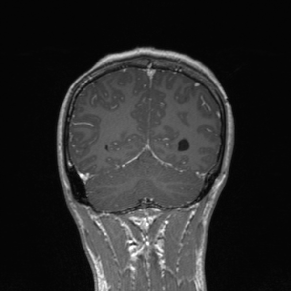 File:Cerebral abscess (Radiopaedia 24212-24478 Coronal T1 C+ 157).jpg