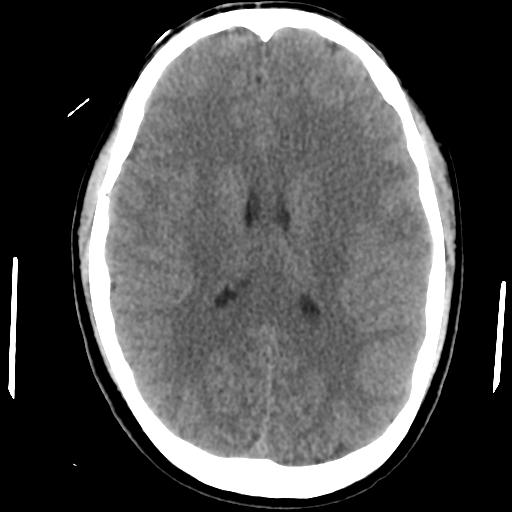 Cerebral abscess (Radiopaedia 29451-29919 Axial non-contrast 29).jpg
