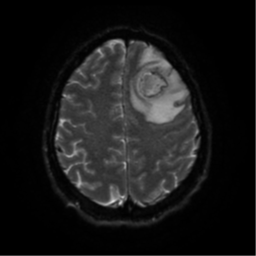 Cerebral abscess (Radiopaedia 57774-64740 Axial DWI 51).png