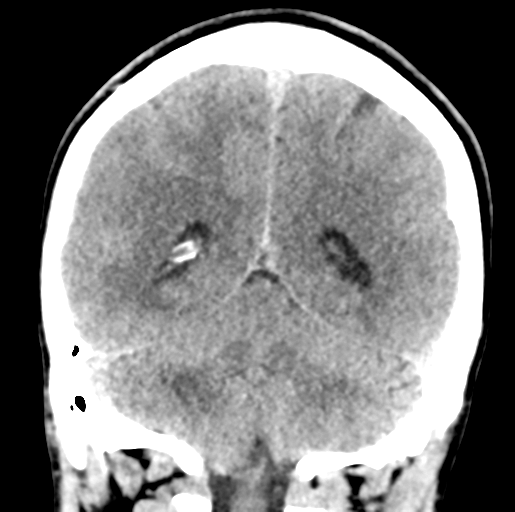 File:Cerebral abscess (Radiopaedia 60342-68008 Coronal non-contrast 45).png