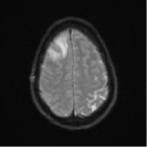 Cerebral abscess (Radiopaedia 60342-68009 Axial DWI 29).png
