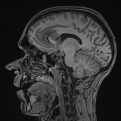 File:Cerebral abscess (Radiopaedia 60342-68009 Sagittal T1 26).png