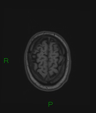 Cerebral abscess and subdural empyema (Radiopaedia 84436-99779 Axial T1 16).jpg