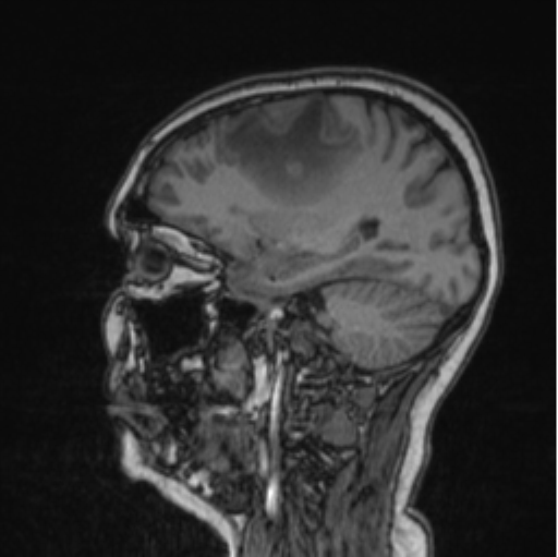 Cerebral abscess from pulmonary arteriovenous malformation (Radiopaedia 86275-102291 Sagittal T1 64).png