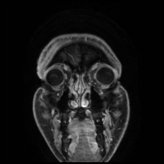 Cerebral abscess with ventriculitis (Radiopaedia 78965-91878 Coronal T1 C+ 9).jpg