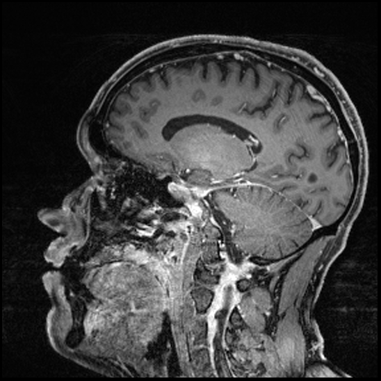 Cerebral abscess with ventriculitis (Radiopaedia 78965-91878 Sagittal T1 C+ 108).jpg