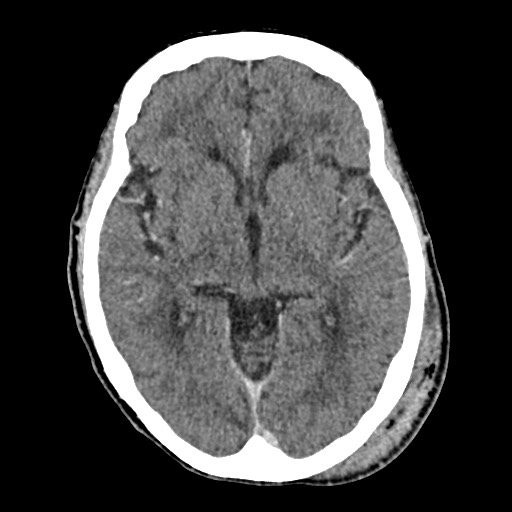 Cerebral amyloid angiopathy-related inflammation (Radiopaedia 74836-85848 Axial non-contrast 30).jpg