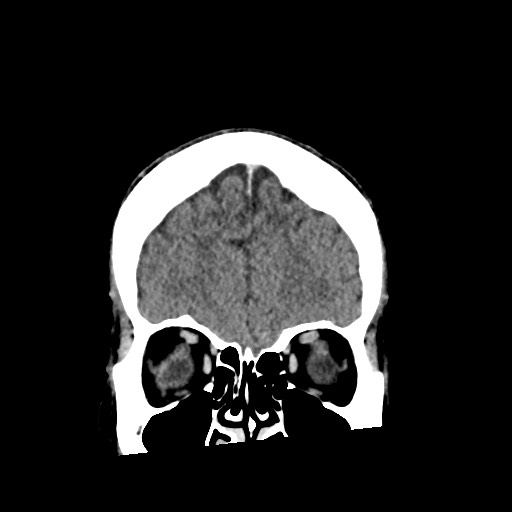 Cerebral amyloid angiopathy-related inflammation (Radiopaedia 74836-85848 Coronal non-contrast 16).jpg