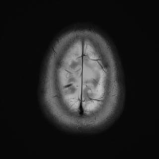 File:Cerebral amyloid angiopathy (Radiopaedia 29129-29518 Axial T2 20).jpg