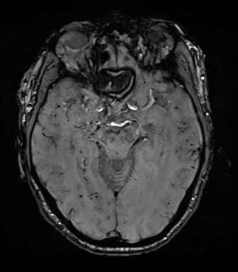 File:Cerebral amyloid angiopathy (Radiopaedia 46082-50433 Axial SWI 33).png