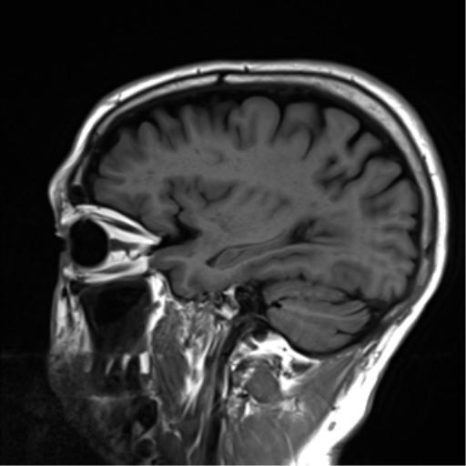 File:Cerebral amyloid angiopathy (Radiopaedia 46082-50433 Sagittal T1 20).png
