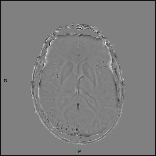 Cerebral amyloid angiopathy (Radiopaedia 77506-89664 H 56).jpg