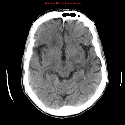 File:Cerebral and orbital tuberculomas (Radiopaedia 13308-13310 Axial non-contrast 31).jpg