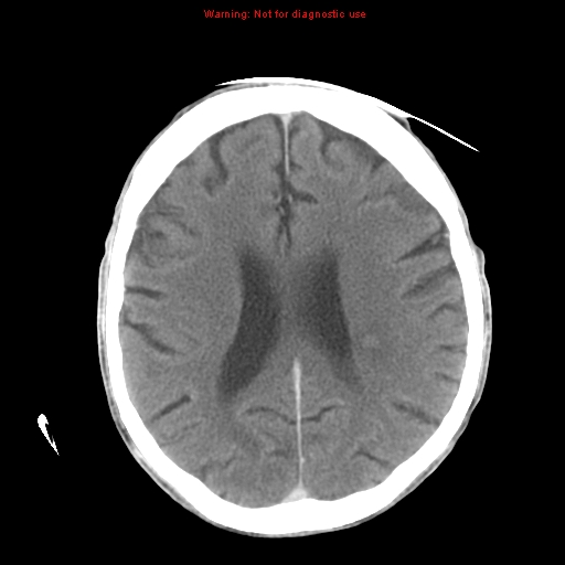 File:Cerebral and orbital tuberculomas (Radiopaedia 13308-13310 B 19).jpg