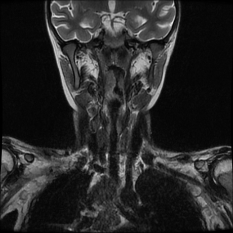 File:Cerebral and spinal tuberculosis (Radiopaedia 90489-107838 Coronal 13).jpg