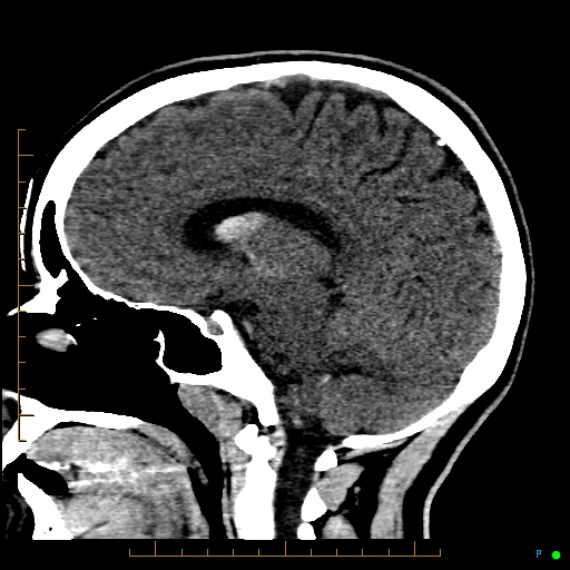 File:Cerebral arteriovenous malformation (AVM) (Radiopaedia 78162-90706 A 43).jpg