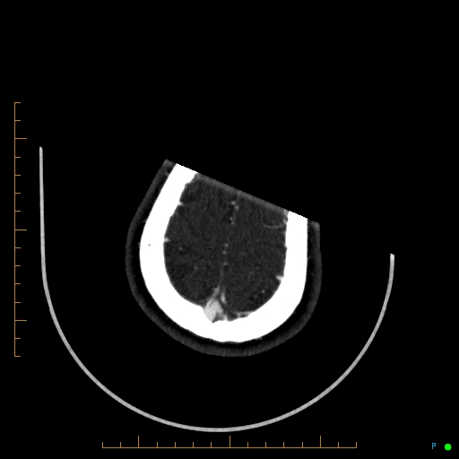 Cerebral arteriovenous malformation (AVM) (Radiopaedia 78162-90706 Axial CTA 242).jpg