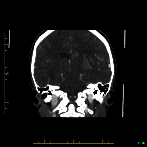 Cerebral arteriovenous malformation (AVM) (Radiopaedia 78162-90706 Coronal CTA 46).jpg