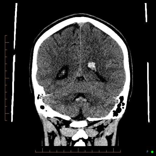 Cerebral arteriovenous malformation (AVM) (Radiopaedia 78162-90706 Coronal non-contrast 68).jpg