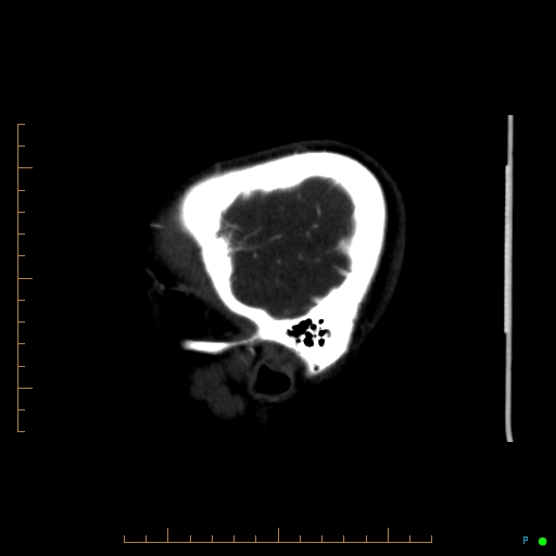 Cerebral arteriovenous malformation (AVM) (Radiopaedia 78162-90706 Sagittal CTA 71).jpg