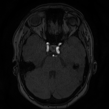 Cerebral arteriovenous malformation (Radiopaedia 74411-85654 Axial MRA 33).jpg